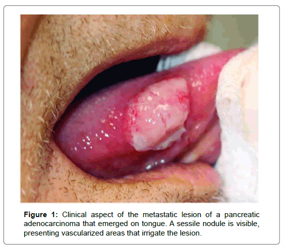 interdisciplinary-medicine-dental-science-adenocarcinoma-emerged