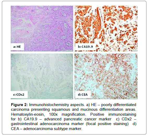 interdisciplinary-medicine-dental-science-adenocarcinoma-marker