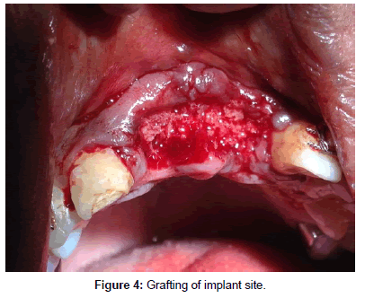 interdisciplinary-medicine-dental-science-grafting