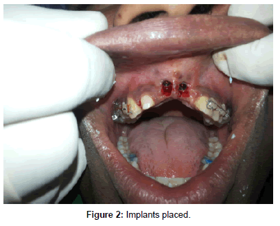 interdisciplinary-medicine-dental-science-implants