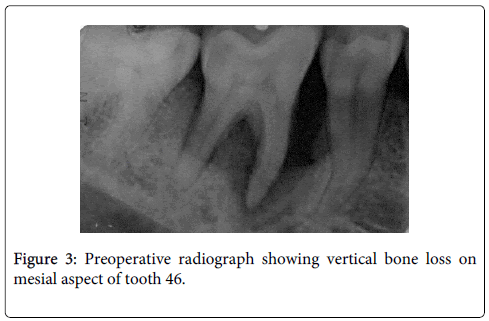 interdisciplinary-medicine-dental-science-mesial-aspect-tooth