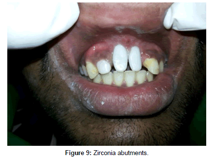 interdisciplinary-medicine-dental-science-zirconia