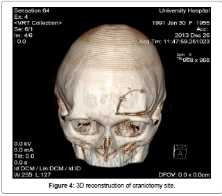 interdisciplinary-reconstruction-craniotomy-site