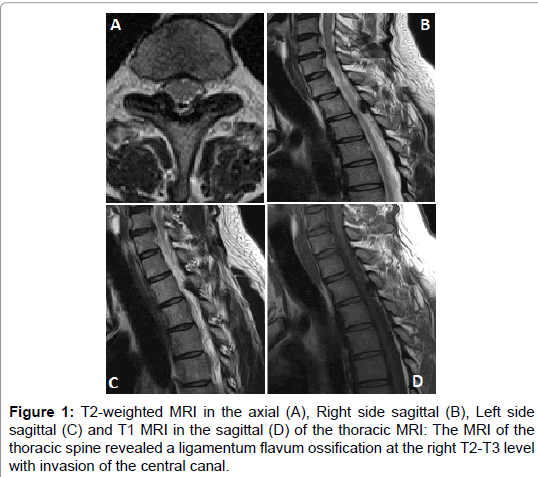 journal-spine-ligamentum-flavum