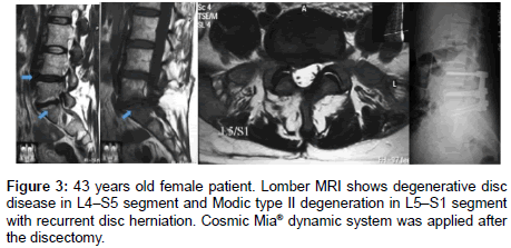 Perspective of Lumbar Segmental Instability for Surgical Evalua tion of ...