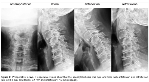 Journals-spine-preoperative-x-rays