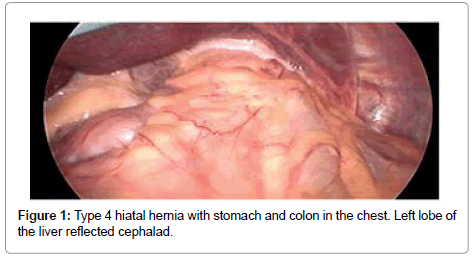 medical-implants-surgery-hiatal-hernia