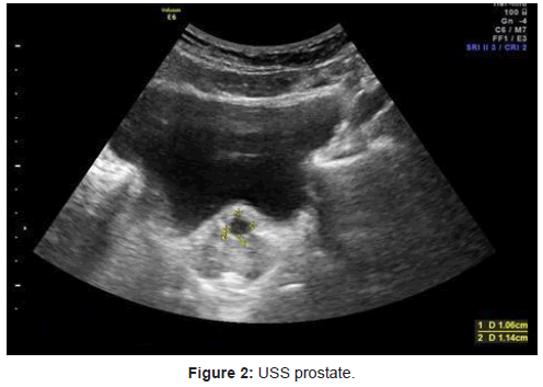 Successful Endoscopic Laser De-roofing of Simple Prostatic Cyst Causing ...