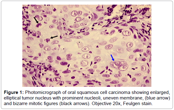 Molecular Biomarkers Diagnosis Photomicrographoral Oral Squamous 