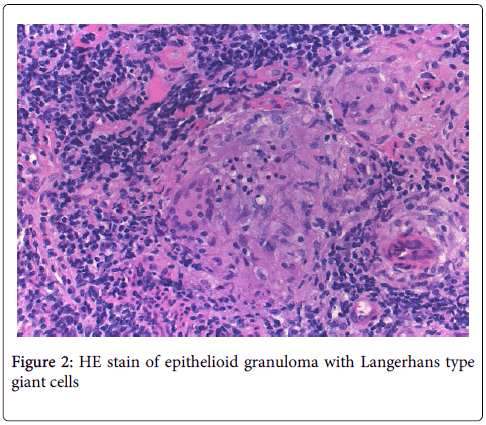 mycobacterial-diseases-giant-cells