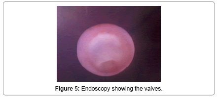 neonatal-and-pediatric-medicine-Endoscopy-showing-valves