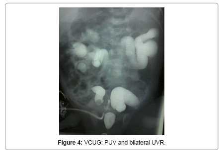 neonatal-and-pediatric-medicine-PUV-bilateral-UVR