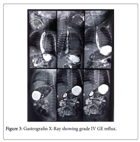 neonatal-and-pediatric-medicine-reflux