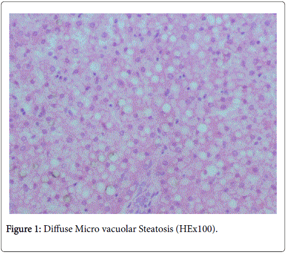 neonatal-pediatric-medicine-micro-vacuolar-steatosis