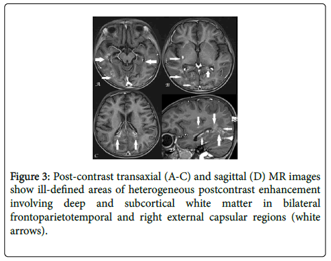 neuroinfectious-diseases-Post-contrast-transaxial