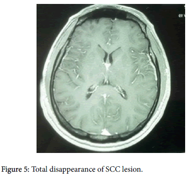 neuroinfectious-diseases-Total-disappearance