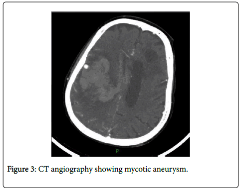 neuroinfectious-diseases-angiography-showing-mycotic-aneurysm