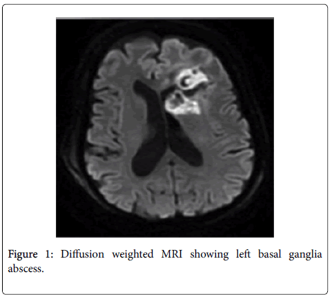 neuroinfectious-diseases-basal-ganglia-abscess