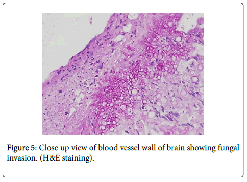 neuroinfectious-diseases-blood-vessel-wall-brain