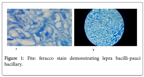 feracco-demonstrating-lepra