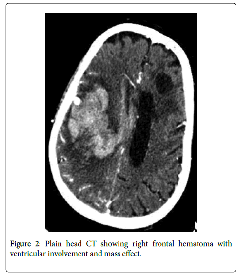 neuroinfectious-diseases-frontal-hematoma-ventricular-involvement