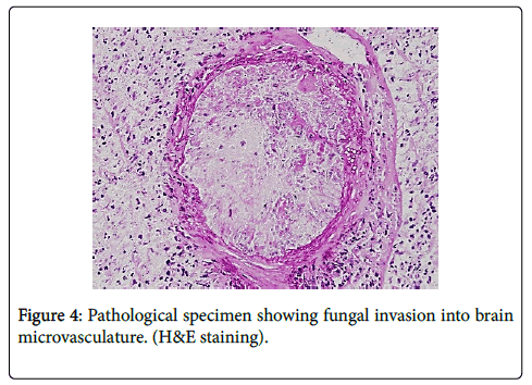 neuroinfectious-diseases-fungal-invasion-brain-microvasculature