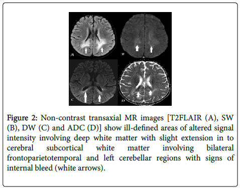 neuroinfectious-diseases-matter-involving-bilateral