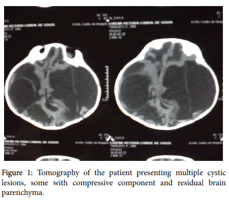 neuroinfectious-diseases-patient-presenting-multiple