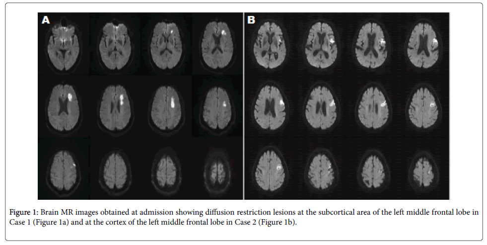  Neurological-disorders-restriction-lesions-subcortical