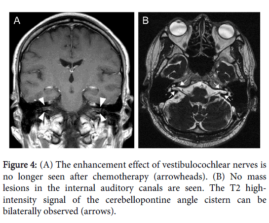 internal auditory canal mri sample dictation