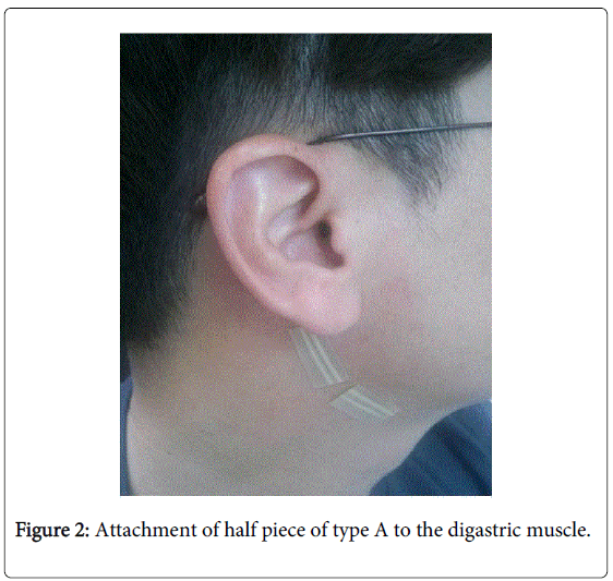 novel-physiotherapies-Attachment-half-piece