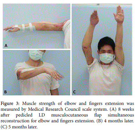 novel-physiotherapies-Muscle-strength