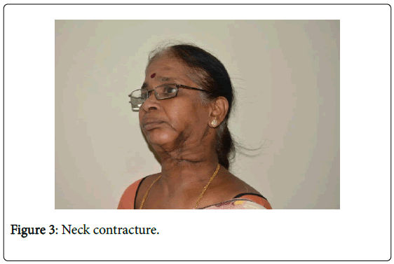 novel-physiotherapies-Neck-contracture