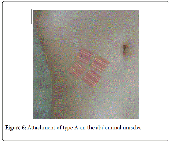 novel-physiotherapies-abdominal-muscles