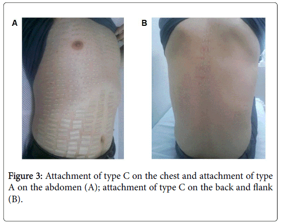 novel-physiotherapies-chest-attachment