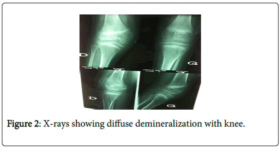 novel-physiotherapies-diffuse-demineralization