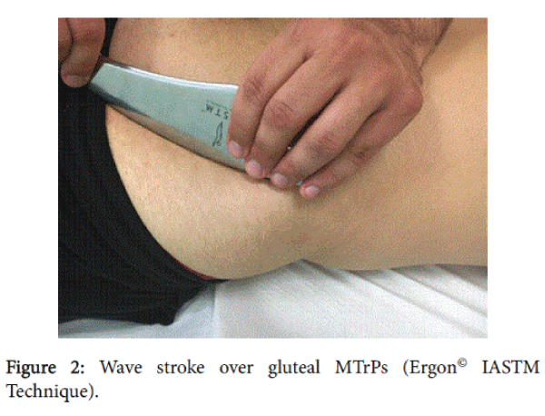 novel-physiotherapies-gluteal-MTrPs