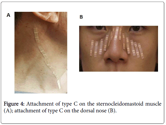 novel-physiotherapies-sternocleidomastoid-muscle