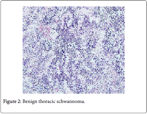 occupational-medicine-health-affairs-Benign-thoracic-schwannoma