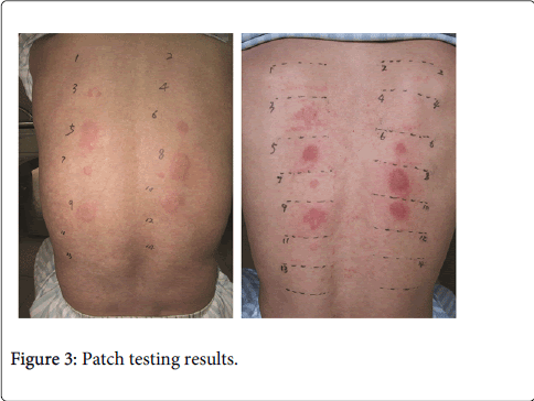 occupational-medicine-health-affairs-Patch-testing