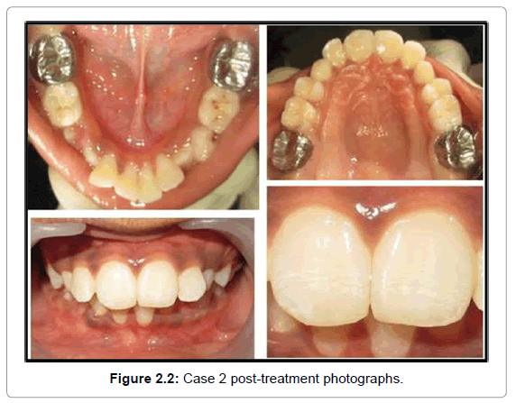 oral-hygiene-health-case-2-post-treatment