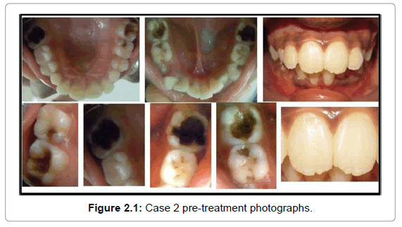 oral-hygiene-health-case-2-pre-treatment