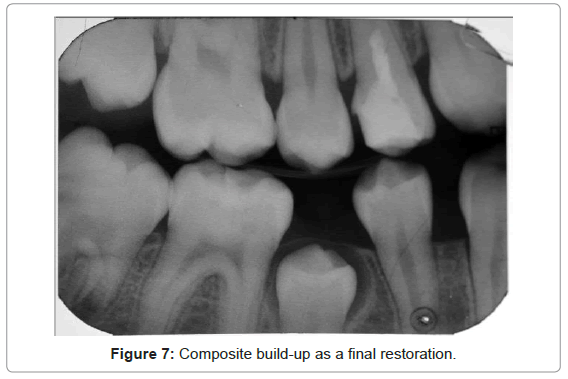 oral-hygiene-health-composite-build-up-2-final