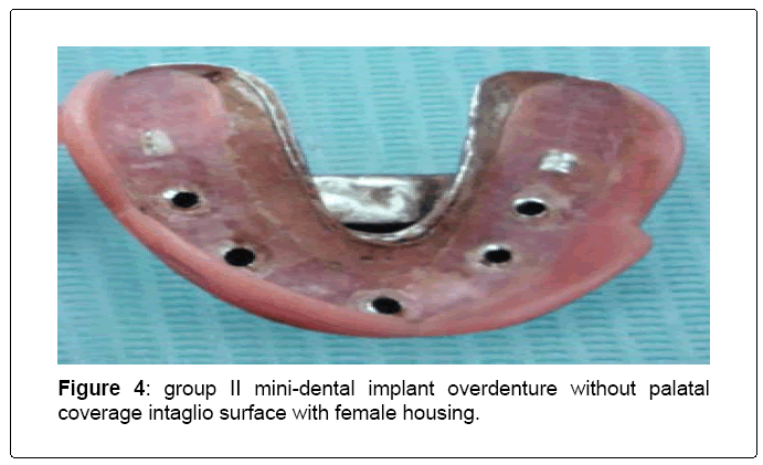 intaglio dental