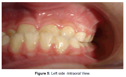 oral-hygiene-health-left-intraoral-View