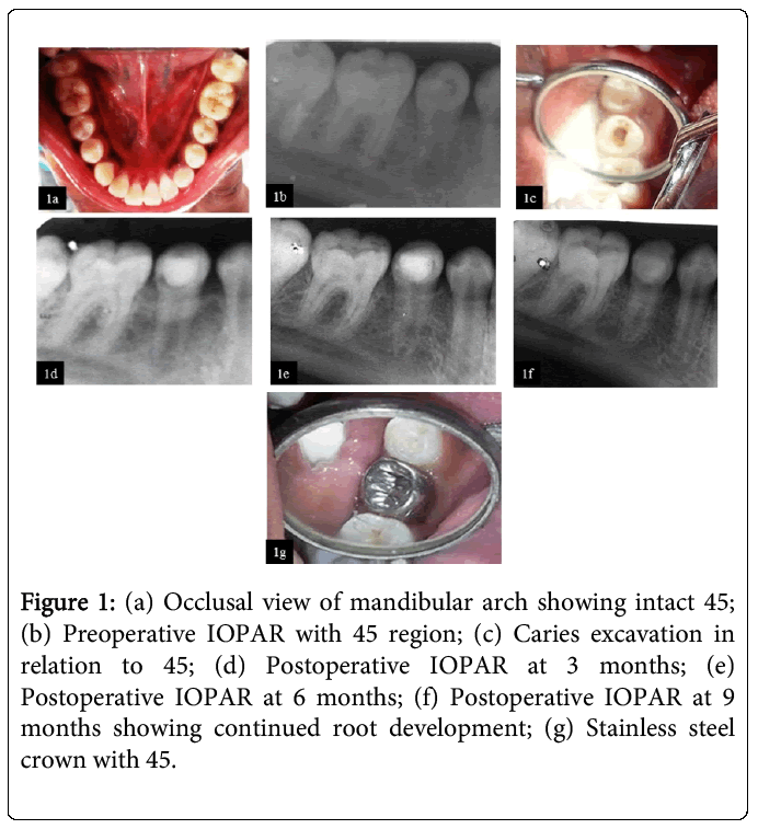 oral-hygiene-health-mandibular