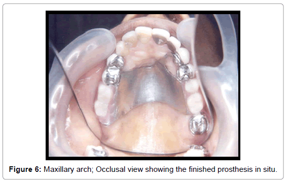 oral-hygiene-health-maxillary-arch-finished