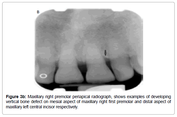 Different Radiographic Modalities Used For Detection Of Common Periodontal And Periapical Lesions Encountered In Routine Dental Practice Omics International