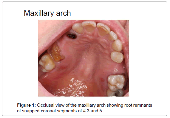 oral-hygiene-health-occlusal-view-maxillary