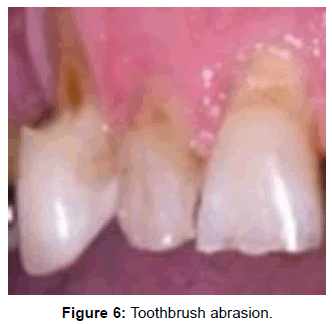 oral-hygiene-health-toothbrush-abrasion